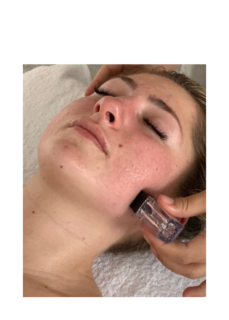RE:LAX Microneedling Stamp and Glow Facial Treatment - 45 mins